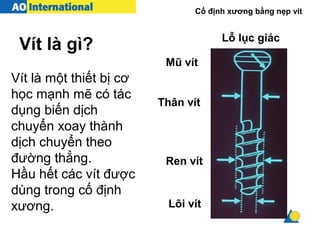 Cố định xương bằng nẹp vít
Vít là một thiết bị cơ
học mạnh mẽ có tác
dụng biến dịch
chuyển xoay thành
dịch chuyển theo
đường thẳng.
Hầu hết các vít được
dùng trong cố định
xương.
Vít là gì?
Mũ vít
Lỗ lục giác
Thân vít
Ren vít
Lõi vít
 