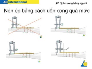 Cố định xương bằng nẹp vít
Nén ép bằng cách uốn cong quá mức
 
