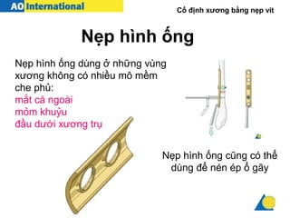 Cố định xương bằng nẹp vít
Nẹp hình ống
Nẹp hình ống dùng ở những vùng
xương không có nhiều mô mềm
che phủ:
mắt cá ngoài
mỏm khuỷu
đầu dưới xương trụ
Nẹp hình ống cũng có thể
dùng để nén ép ổ gãy
 