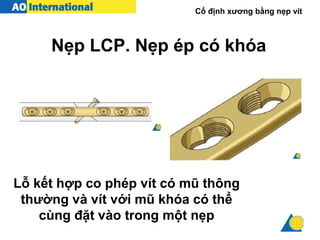 Cố định xương bằng nẹp vít
Lỗ kết hợp co phép vít có mũ thông
thường và vít với mũ khóa có thể
cùng đặt vào trong một nẹp
Nẹp LCP. Nẹp ép có khóa
 