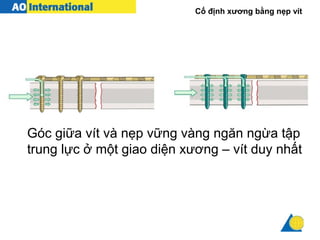 Cố định xương bằng nẹp vít
Góc giữa vít và nẹp vững vàng ngăn ngừa tập
trung lực ở một giao diện xương – vít duy nhất
 
