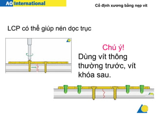 Cố định xương bằng nẹp vít
LCP có thể giúp nén dọc trục
Chú ý!
Dùng vít thông
thường trước, vít
khóa sau.
 