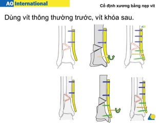 Cố định xương bằng nẹp vít
Dùng vít thông thường trước, vít khóa sau.
 
