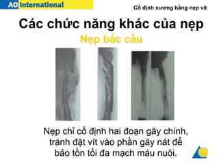 Cố định xương bằng nẹp vít
Các chức năng khác của nẹp
Nẹp bắc cầu
Nẹp chỉ cố định hai đoạn gãy chính,
tránh đặt vít vào phần gãy nát để
bảo tồn tối đa mạch máu nuôi.
 