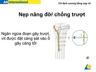 Cố định xương bằng nẹp vít
Ngăn ngừa đoạn gãy trượt,
vít được đặt càng sát vào ổ
gãy càng tốt
Nẹp nâng đỡ/ chống trượt
 