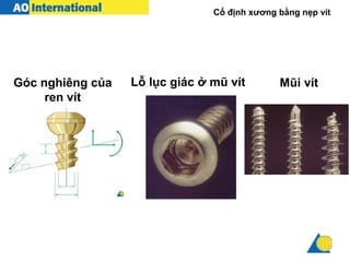 Cố định xương bằng nẹp vít
Góc nghiêng của
ren vít
Lỗ lục giác ở mũ vít Mũi vít
 