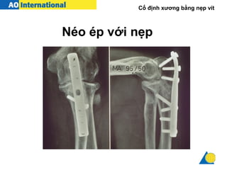 Cố định xương bằng nẹp vít
Néo ép với nẹp
 