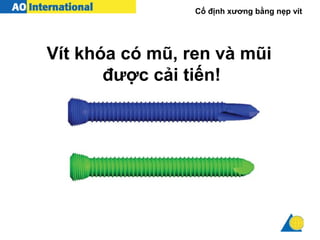 Cố định xương bằng nẹp vít
Vít khóa có mũ, ren và mũi
được cải tiến!
 