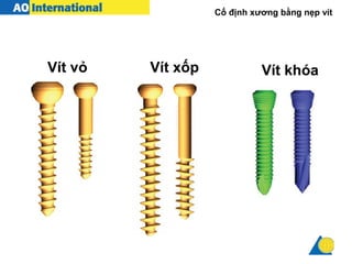 Cố định xương bằng nẹp vít
Vít vỏ Vít xốp Vít khóa
 