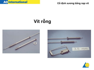 Cố định xương bằng nẹp vít
Vít rỗng
 