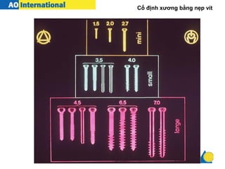 Cố định xương bằng nẹp vít
 