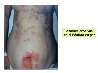 . Lesiones erosivas
en el Pénfigo vulgar
 