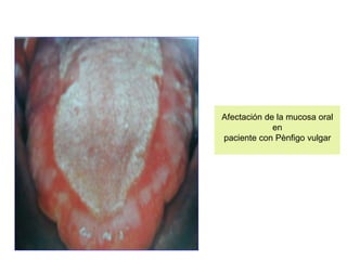 Afectación de la mucosa oral
en
paciente con Pènfigo vulgar
 