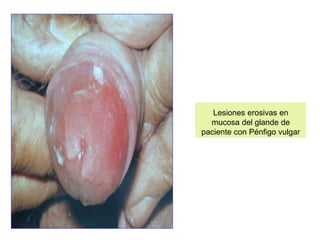 Lesiones erosivas en
mucosa del glande de
paciente con Pénfigo vulgar
 