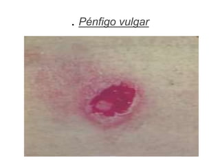 . Pénfigo vulgar
 