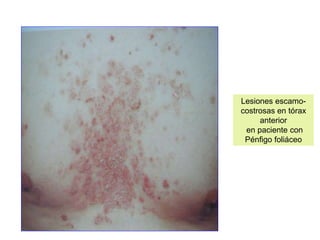 Lesiones escamo-
costrosas en tórax
anterior
en paciente con
Pénfigo foliáceo
 