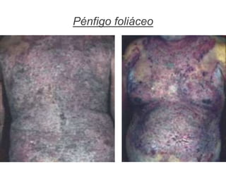 Pénfigo foliáceo
 