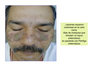 . Lesiones escamo-
costrosas en la cara
como
Alas de mariposa que
simulan un lupus
eritematoso
en paciente con Pénfigo
eritematoso
 