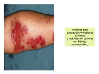 Ampollas bien
constituidas y erosiones
extensas
y profundas en paciente
con Pénfigo
paraneoplásico
 