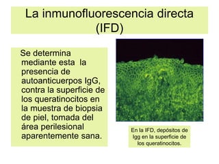 La inmunofluorescencia directa
(IFD)
Se determina
mediante esta la
presencia de
autoanticuerpos IgG,
contra la superficie de
los queratinocitos en
la muestra de biopsia
de piel, tomada del
área perilesional
aparentemente sana.
En la IFD, depósitos de
Igg en la superficie de
los queratinocitos.
 