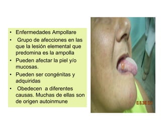 • Enfermedades Ampollare
• Grupo de afecciones en las
que la lesión elemental que
predomina es la ampolla
• Pueden afectar la piel y/o
mucosas.
• Pueden ser congénitas y
adquiridas
• Obedecen a diferentes
causas. Muchas de ellas son
de origen autoinmune
 
