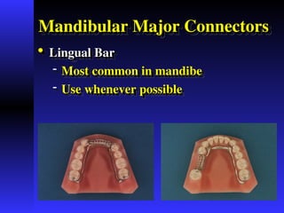 Comprehensive Overview of Major Connectors in Partial Dentures: Design ...