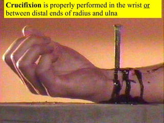 Crucifixion  is properly performed in the wrist  or   between distal ends of radius and ulna 