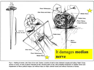 It damages  median nerve 