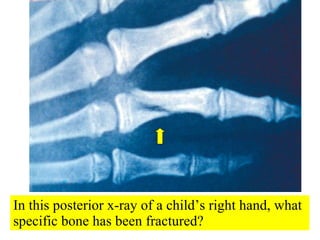 In this posterior x-ray of a child’s right hand, what specific bone has been fractured? 