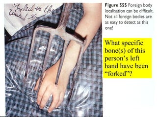 What specific bone(s) of this person’s left hand have been “forked”? 