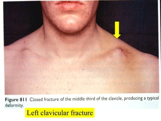Left clavicular fracture 