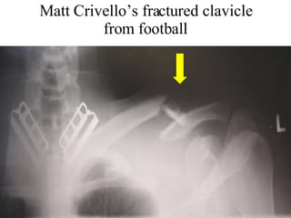 Matt Crivello’s fractured clavicle from football 