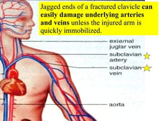 Jagged ends of a fractured clavicle  can easily damage underlying arteries and veins  unless the injured arm is quickly immobilized. 