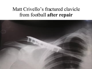 Matt Crivello’s fractured clavicle from football  after repair 