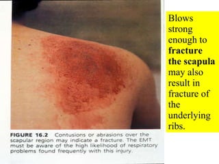 Blows strong enough to  fracture the scapula  may also result in fracture of the underlying ribs. 