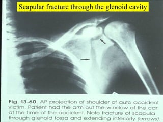 Scapular fracture through the glenoid cavity 