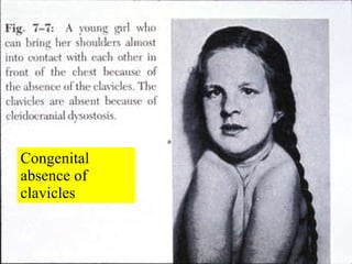 Congenital absence of clavicles 