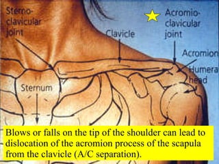 Blows or falls on the tip of the shoulder can lead to dislocation of the acromion process of the scapula from the clavicle (A/C separation). 