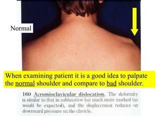 When examining patient it is a good idea to palpate the  normal  shoulder and compare to  bad  shoulder. Normal 