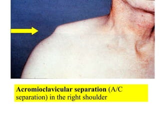 Acromioclavicular separation  (A/C separation) in the right shoulder 