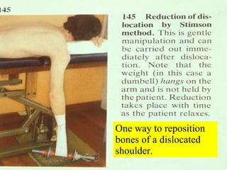 One way to reposition bones of a dislocated shoulder. 