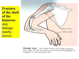 Fracture of the shaft of the humerus  may damage nearby nerves. 