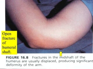 Open fracture of humeral shaft. 