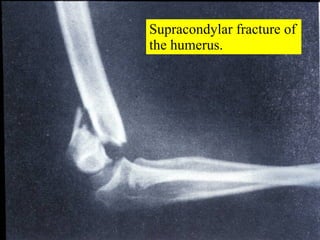 Supracondylar fracture of the humerus. 