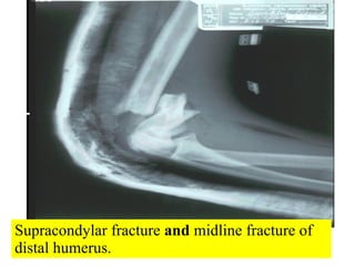Supracondylar fracture  and  midline fracture of distal humerus. 