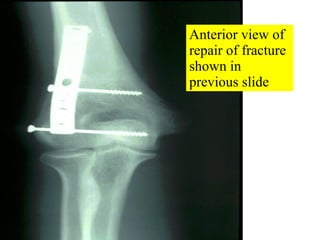 Anterior view of repair of fracture shown in previous slide 