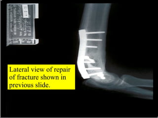 Lateral view of repair of fracture shown in previous slide. 