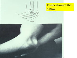 Dislocation of the elbow. 