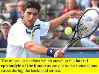 The muscular tendons which attach to the  lateral epicondyle of the humerus  are put under tremendous stress during the backhand stroke. 