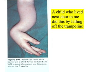 A child who lived next door to me did this by falling off the trampoline 